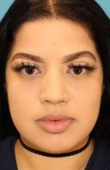 Buccal Fat Pad Before & After Patient #6436