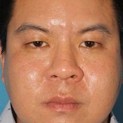Buccal Fat Pad Before & After Patient #6441