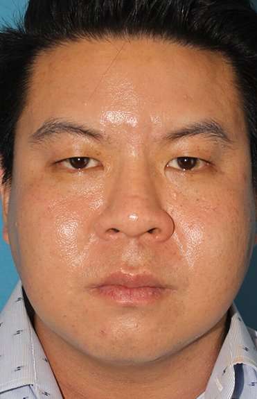 Buccal Fat Pad Before & After Patient #6441