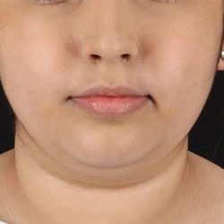 Buccal Fat Pad Before & After Patient #6452
