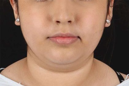 Buccal Fat Pad Before & After Patient #6452