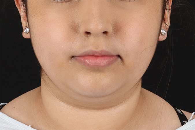 Buccal Fat Pad Before & After Patient #6452