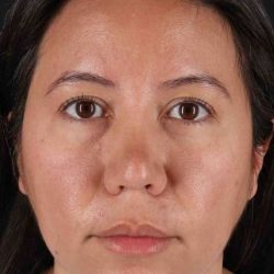 Buccal Fat Pad Before & After Patient #6463