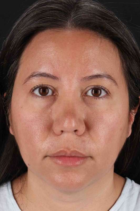 Buccal Fat Pad Before & After Patient #6463