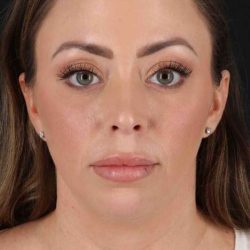 Buccal Fat Pad Before & After Patient #6474