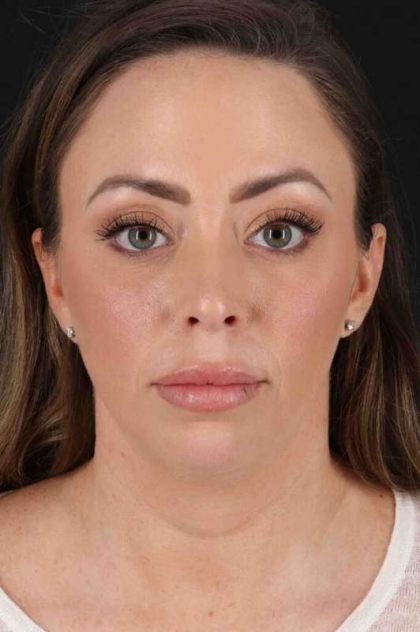 Buccal Fat Pad Before & After Patient #6474