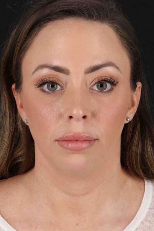 Buccal Fat Pad Before & After Patient #6474