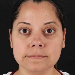 Buccal Fat Pad Before & After Patient #6485