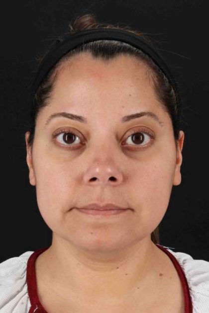 Buccal Fat Pad Before & After Patient #6485