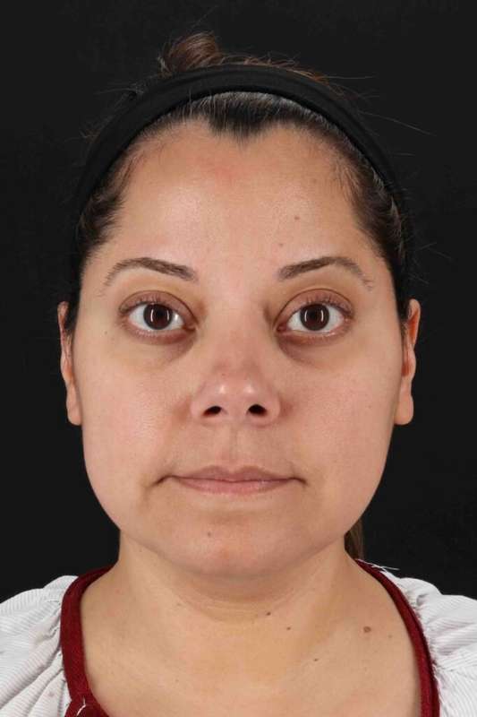 Buccal Fat Pad Before & After Patient #6485