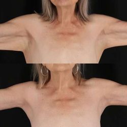 Brachioplasty (Arm Lift) Before & After Patient #1175