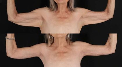 Brachioplasty (Arm Lift) Before & After Patient #1175