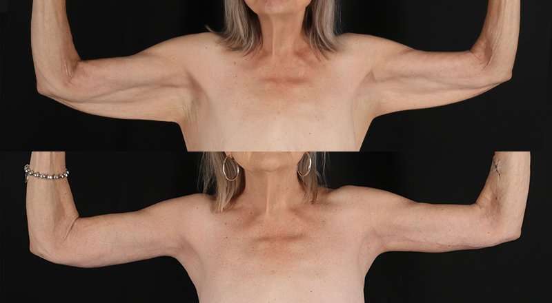Brachioplasty (Arm Lift) Before & After Patient #1175