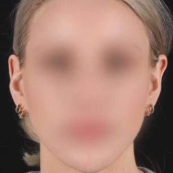 Otoplasty Before & After Patient #6506