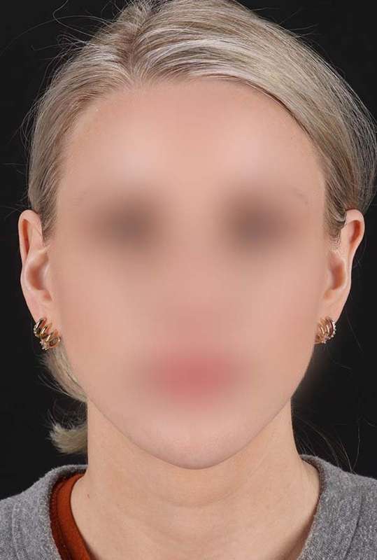 Otoplasty Before & After Patient #6506
