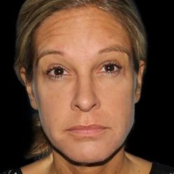 Neck Lift Before & After Patient #6517