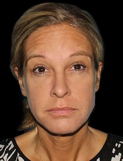 Neck Lift Before & After Patient #6517