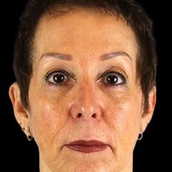 Neck Lift Before & After Patient #6528