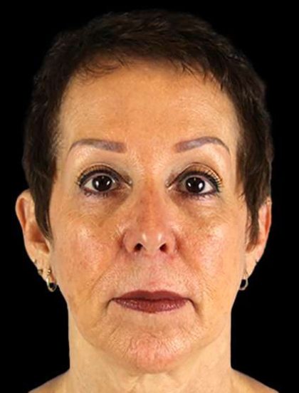 Neck Lift Before & After Patient #6528