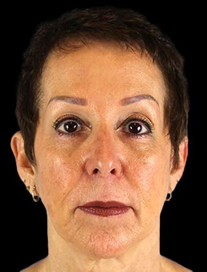 Neck Lift Before & After Patient #6528
