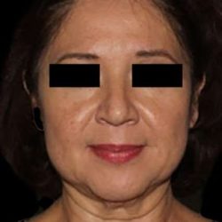 Neck Lift Before & After Patient #6539