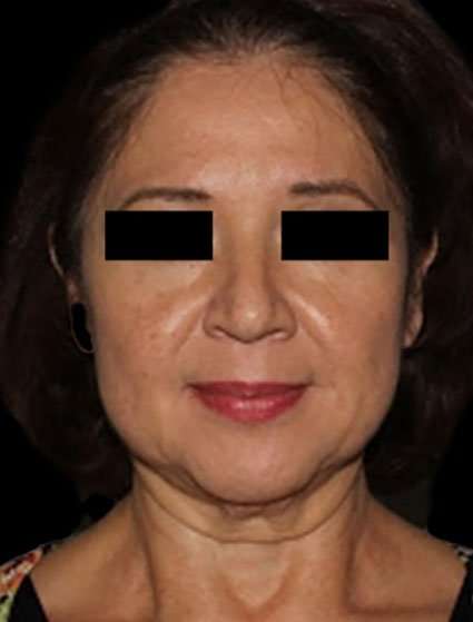 Neck Lift Before & After Patient #6539