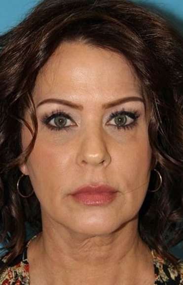 Neck Lift Before & After Patient #6546