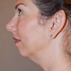 Neck Lift Before & After Patient #6549