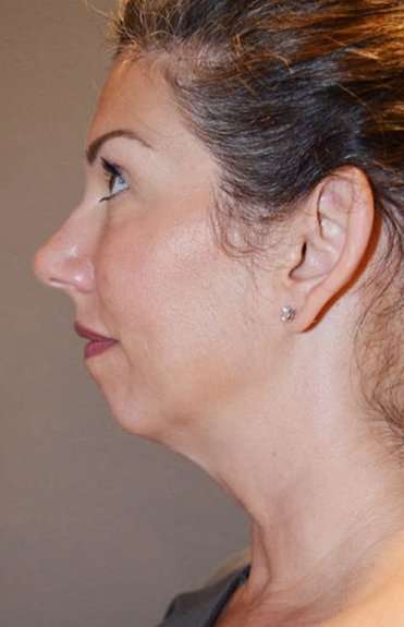Neck Lift Before & After Patient #6549
