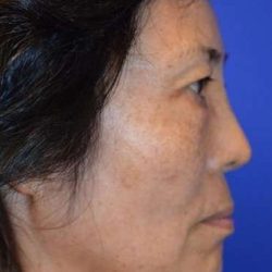 Neck Lift Before & After Patient #6552