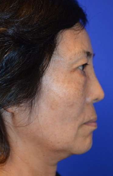 Neck Lift Before & After Patient #6552