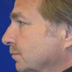 Neck Lift Before & After Patient #6555