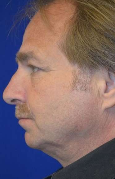 Neck Lift Before & After Patient #6555
