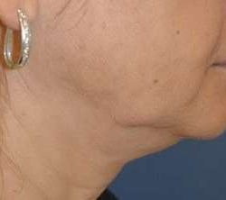 Neck Lift Before & After Patient #6558