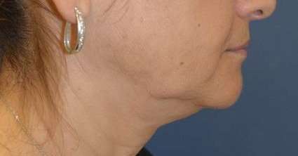 Neck Lift Before & After Patient #6558