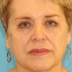 Neck Lift Before & After Patient #6565