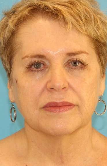 Neck Lift Before & After Patient #6565