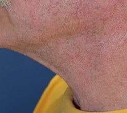 Neck Lift Before & After Patient #6568