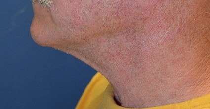 Neck Lift Before & After Patient #6568