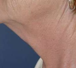 Neck Lift Before & After Patient #6571