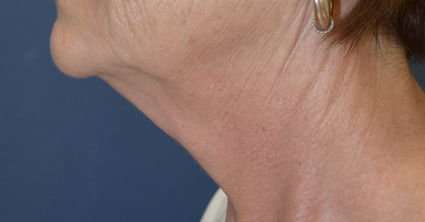 Neck Lift Before & After Patient #6571