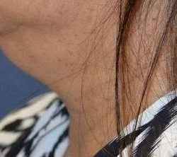 Neck Lift Before & After Patient #6574