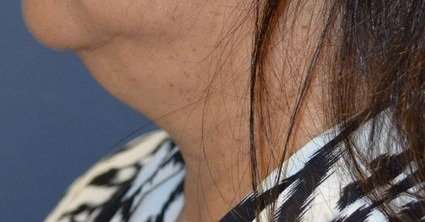 Neck Lift Before & After Patient #6574