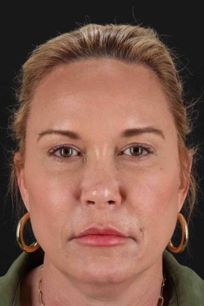 Neck Lift Before & After Patient #6620