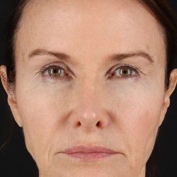 Neck Lift Before & After Patient #6631