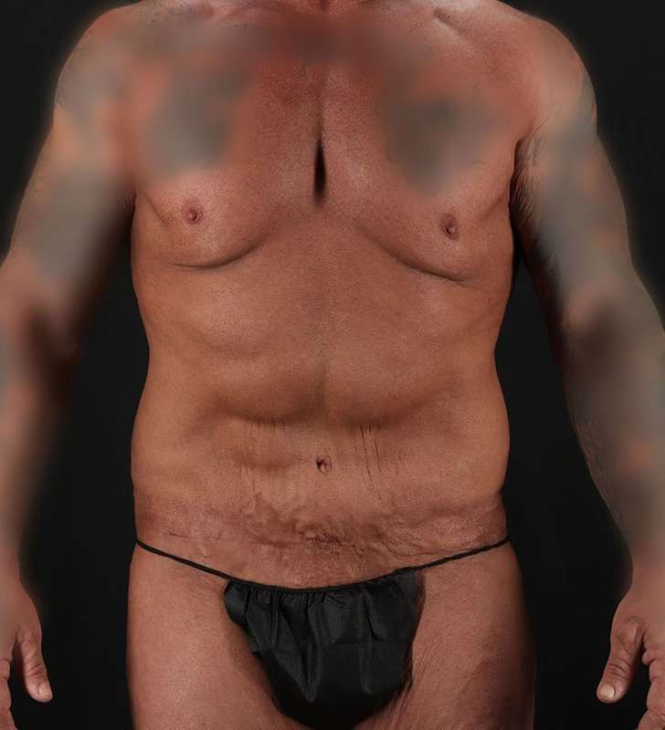 Cosmetic Body Lift Before & After Patient #1200