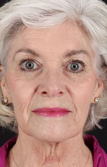 Neck Lift Before & After Patient #6665