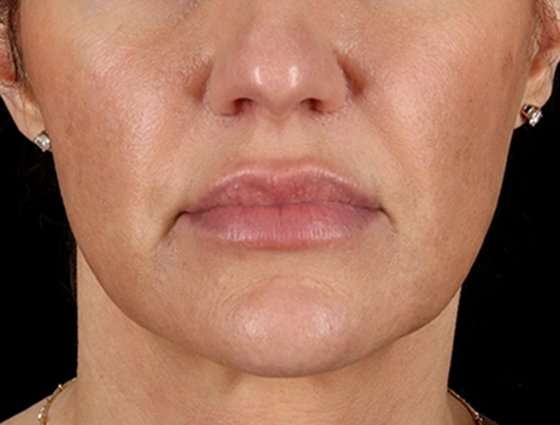 Neck Lift Before & After Patient #6676
