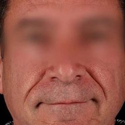 Neck Lift Before & After Patient #6698