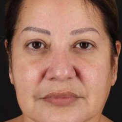Neck Lift Before & After Patient #6709
